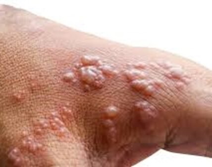 monkeypox
