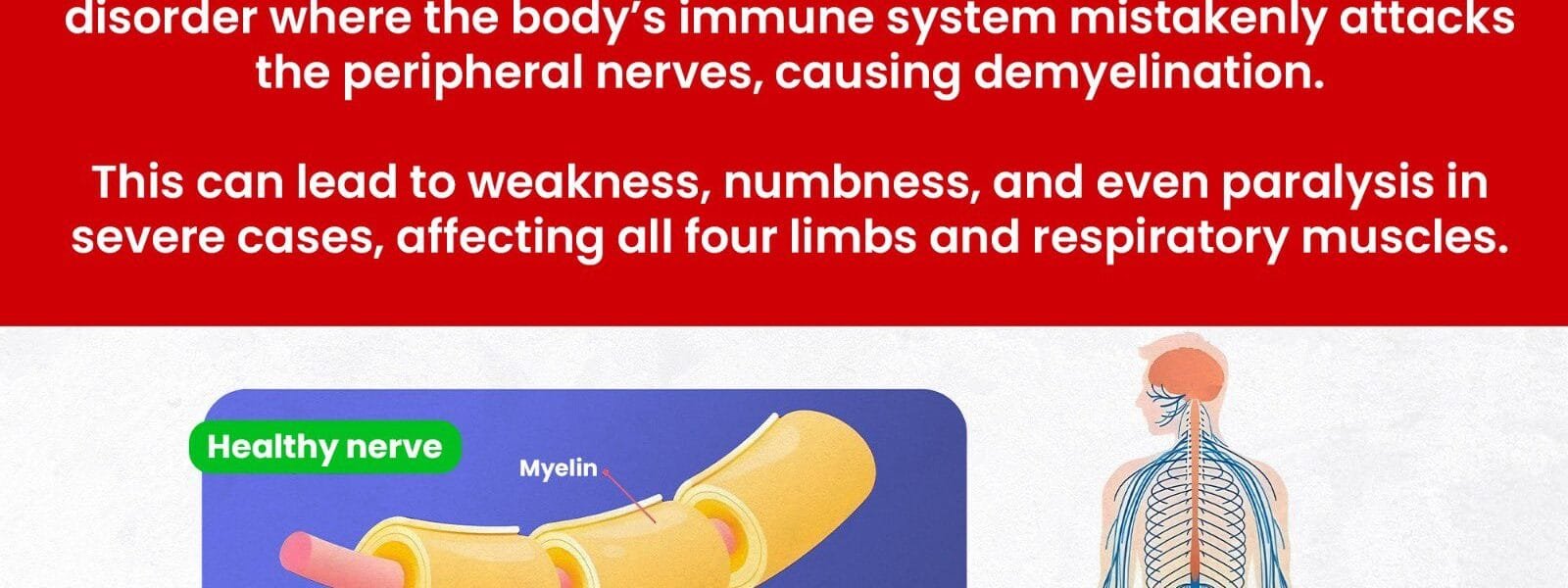 Three new suspected cases of Guillain-Barre Syndrome-GBS detected in Maharashtra