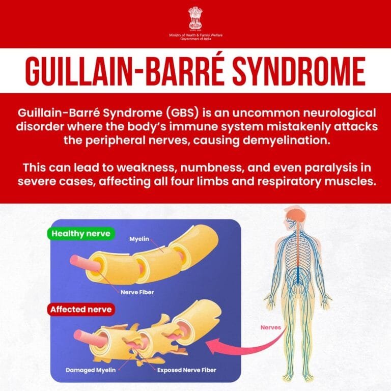 महाराष्ट्र में गुइलेन-बैरे सिंड्रोम-GBS के तीन नए संदिग्ध मामलों का पता चला